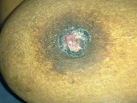 breast lump could be cancer | cancer of the breast | Cancer Sri Lanka