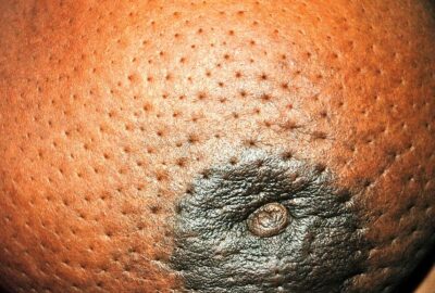peau d'orange (Source - http://healthitis.blogspot.com/) - Cancer In Sri Lanka