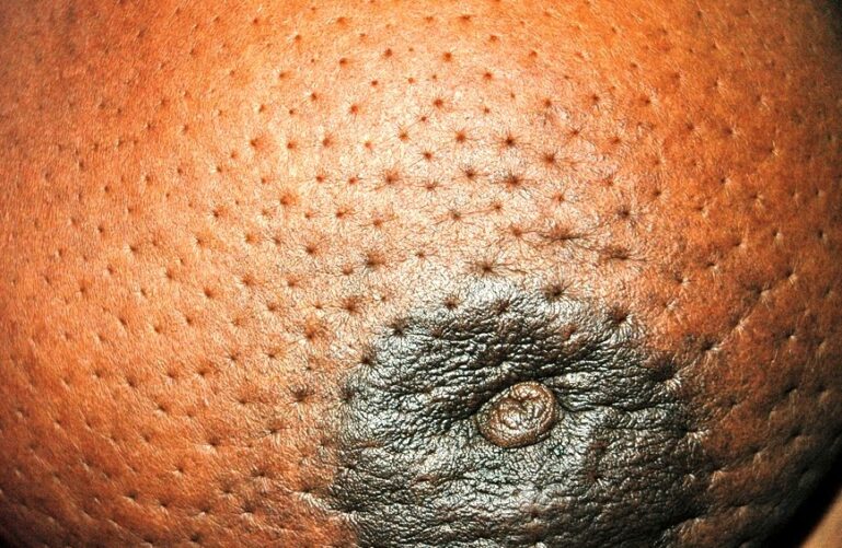 peau d'orange (Source - http://healthitis.blogspot.com/) - Cancer In Sri Lanka