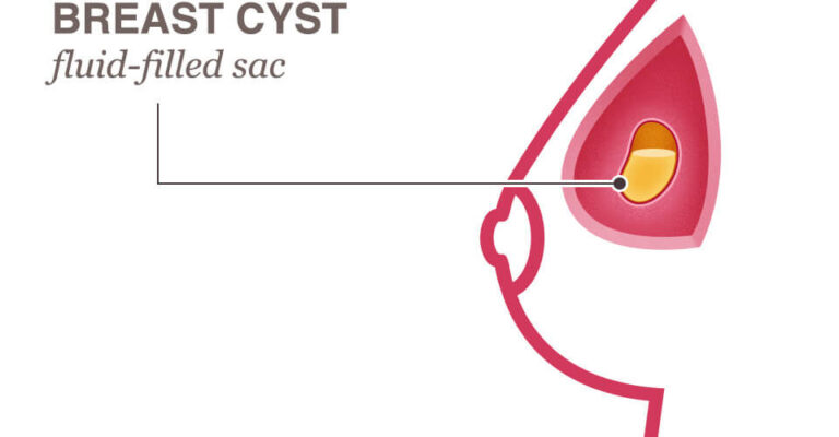 Breast Cyst - Cancer In Sri Lanka